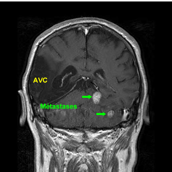 Metastase cerebrale en IRM