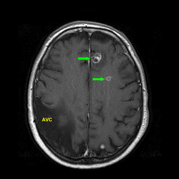 Metastase cerebrale en IRM