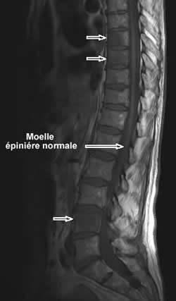 Images IRM de métastases vertebrales d'un cancer bronchique à l'IRM