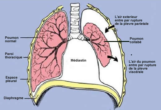 pneumothorax